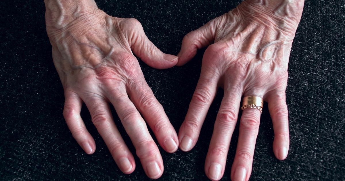 It's important to manage arthritis symptoms as much as possible.
